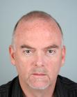 Before Hair Transplant&nbsp;2 Sessions (Areas)